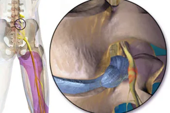 SCIATICA NERVE | Get Rid of Lower Back Pain