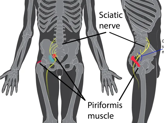 Sciatica Treatments
